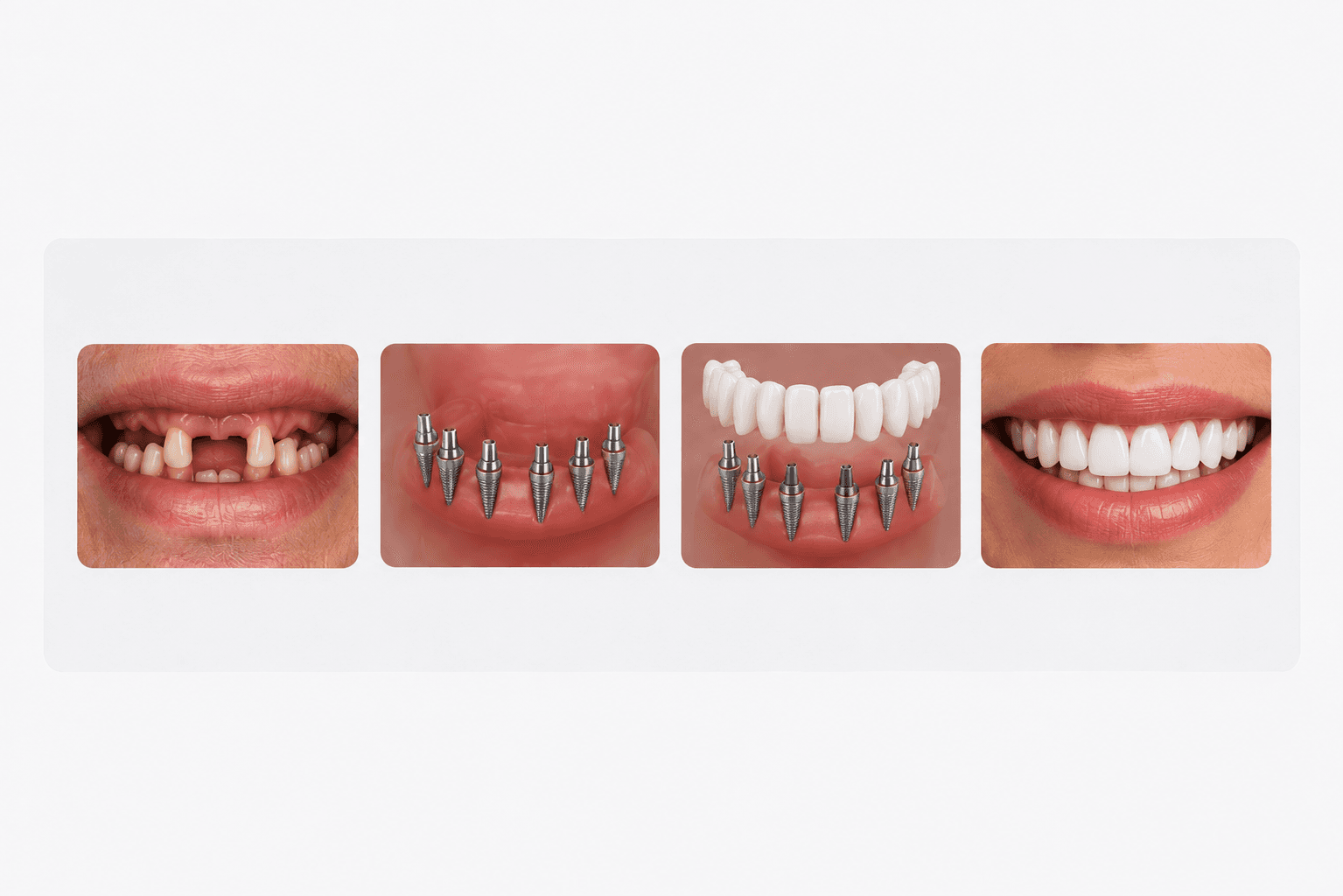 Full Arch Restoration