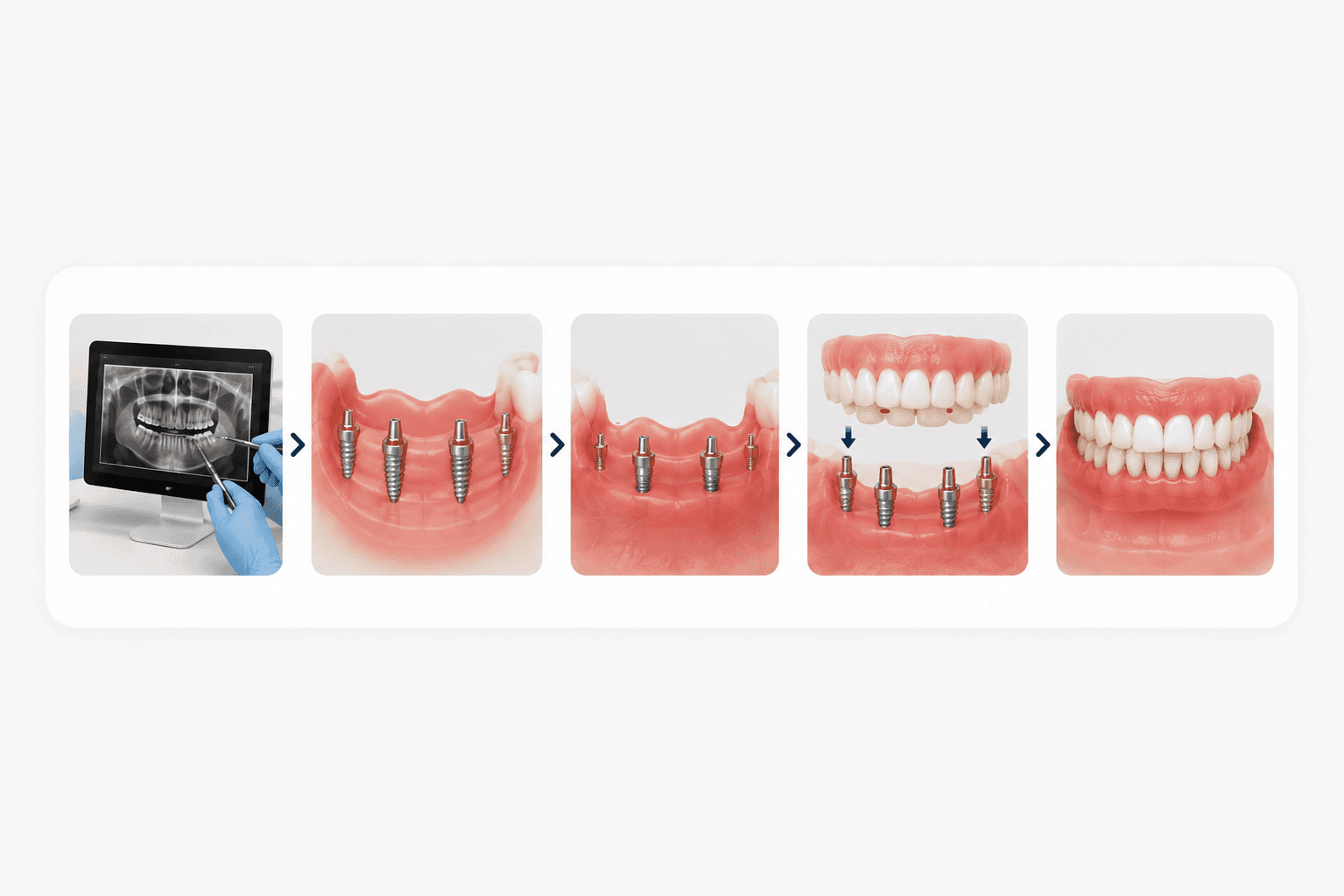 Implant Supported Dentures